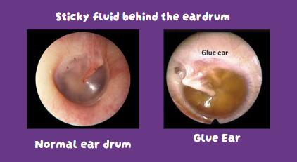 Glue ear image - My Little Ears